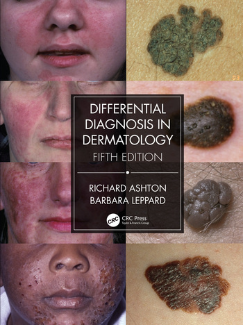 Differential Diagnosis in Dermatology CRC Press