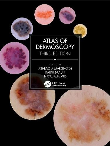 Atlas of Dermoscopy, Third Edition Taylor & Francis Ltd