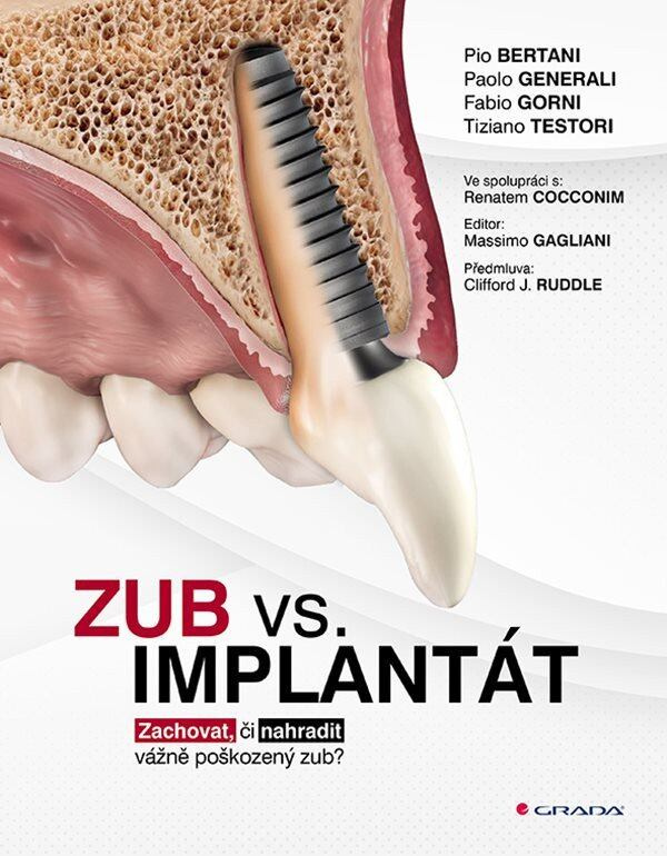 Zub vs. implantát - Pio Bertani, Paolo Generali, Fabio Gorni, Tiziano Testori