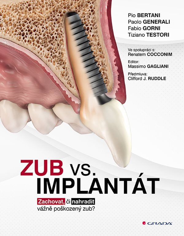 Zub vs. implantát - Pio Bertani, Paolo Generali, Fabio Gorni, Tiziano Testori
