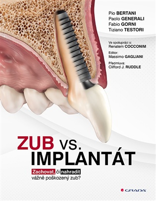 Zub vs. implantát - Pio Bertani, Paolo Generali, Fabio Gorni, Tiziano Testori