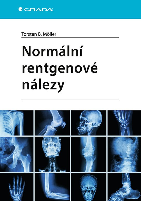 E-kniha: Normální rentgenové nálezy od Möller Torsten B.