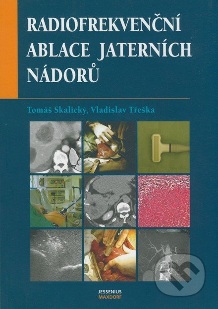 Radiofrekvenční ablace jaterních nádorů - Tomáš Skalický, Vladislav Třeška - kniha z kategorie Onkologie