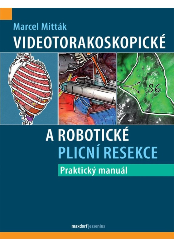 Videotorakoskopické a robotické plicní resekce - Marcel Mitták